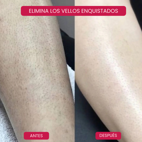Depiladora indolora Lumicrystal™
